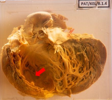Aneurysmal dilatation Aneurysmal dilatation